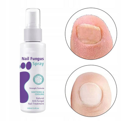 Advanced Foot and Nail Fungus Spray 100 ml